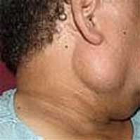 Facial Nerve Tumor or Pleomorphic Adenoma How to ...