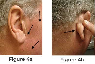Symptoms of Facial Nerve Cancer and Treatment Procedure